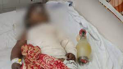 Horrific Death of Girl Child in Indore उबलते पानी में गिरी मासूम, मौत