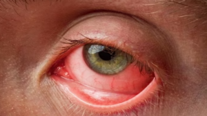 Eye Flu: Pink Eye को लेकर छत्तीसगढ़ स्वास्थ्य विभाग ने जारी किया सर्कुलर, इन आई ड्रॉप को लेने की दी सलाह