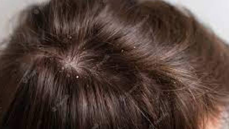 Dandruff: डैंड्रफ दूर करने का घरेलु उपाय, बालों का टूटना-झड़ना भी होगा कम