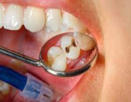 Teeth Cavity: दांतों में लंबे समय से लगे कीड़ों से हैं परेशान, तो अपनाएं ये घरेलु नुस्खे