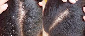 Dandruff Tips: सर्दियों में बढ़ते डैंड्रफ से परेशान?, तो आज ही अपनाएं ये टिप्स