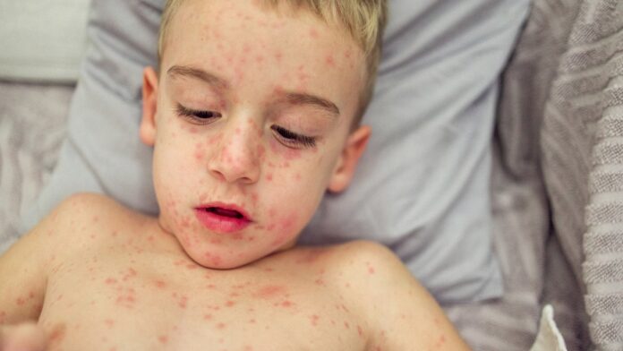 Measles Symptoms: बच्चों में फैल रहा इस बीमारी का खतरा