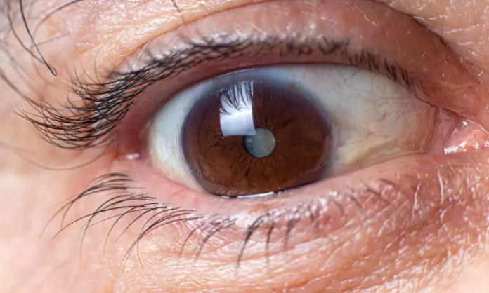Health Tips: आंखों की इस बीमारी की चपेट में आ रहे है करोड़ों लोग, जानें इसके लक्षण