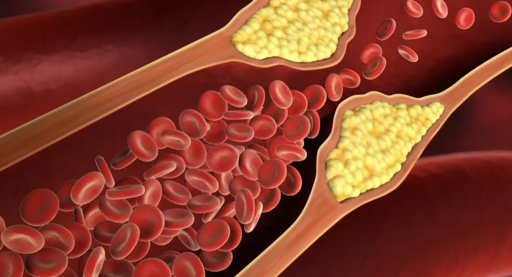 High cholesterol: हाई कोलेस्ट्रॉल दिल का दुश्मन, समय रहते करें पहचान